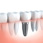 implantes-dentales