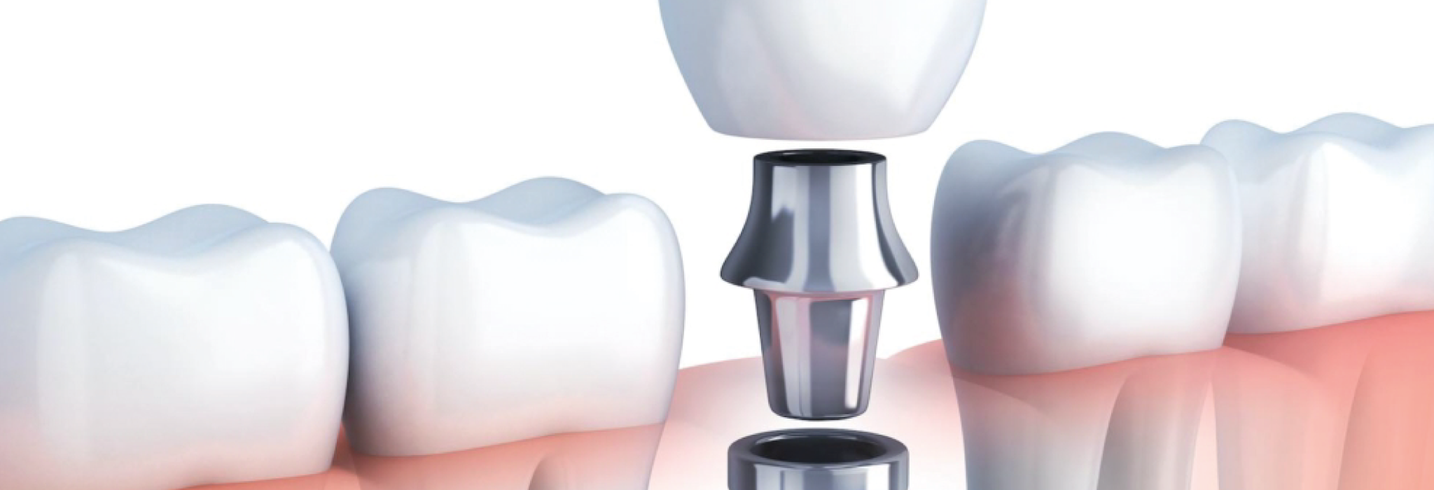 Implantes-dentales-2