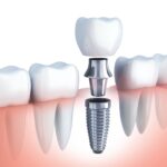 implante-dental